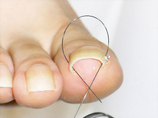 巻き爪ワイヤー